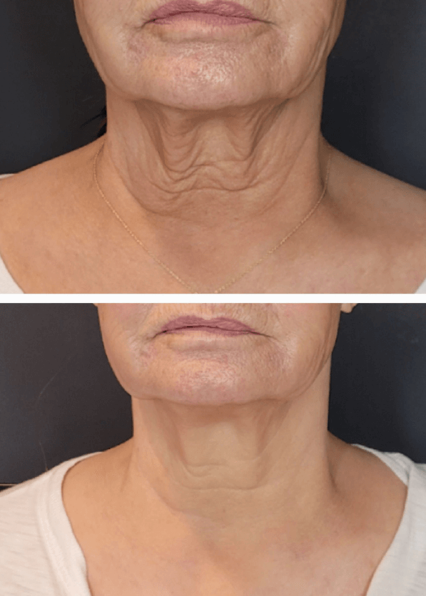 Before and After Neck